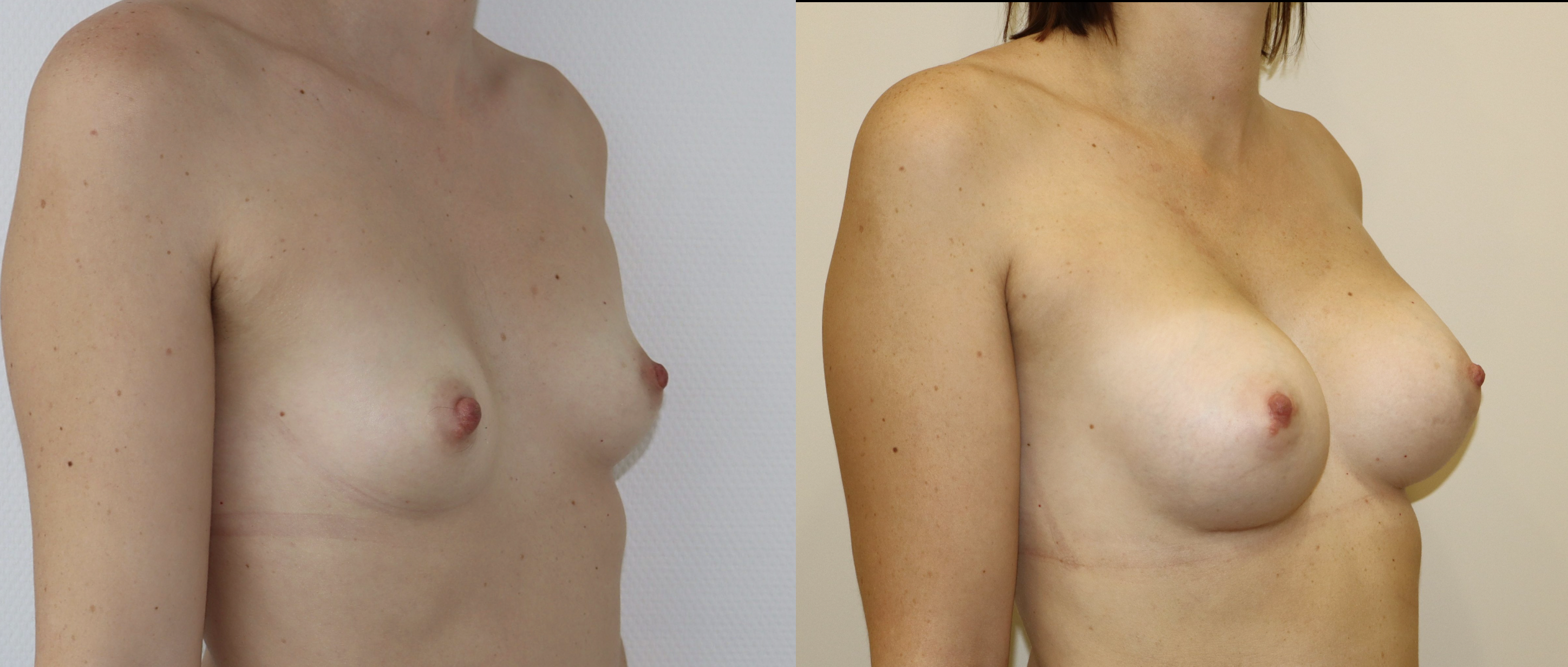 Avant/Après prothèses mammaires